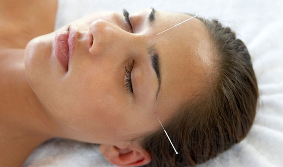 Acupuncture in SF: A Beginner's Guide